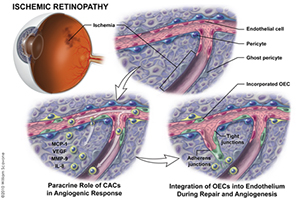 Retinopathy-Associated Revascularization Thumbnail
