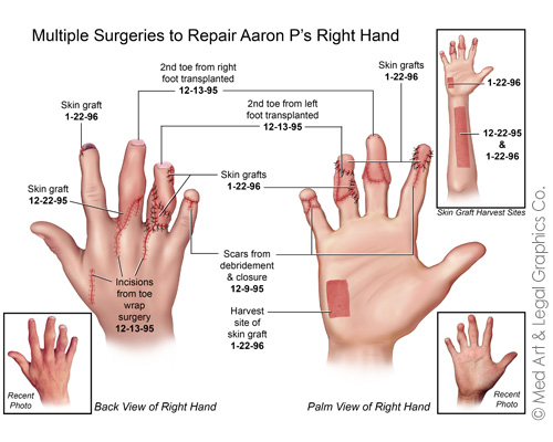 Multiple Surgeries to Repair Aaron P's Right Hand