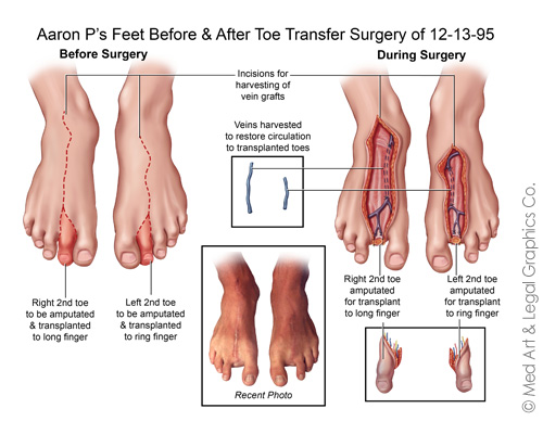 Aaron P's Feet Before and After Surgery