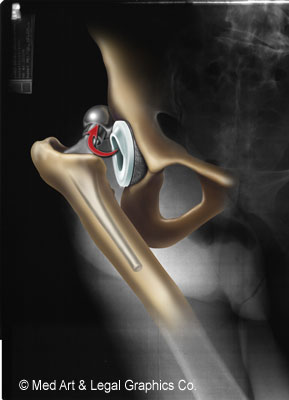 Prosthetic Hip Dislocation