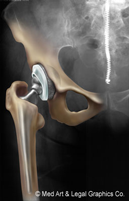 Replacement Hip Radiograph After Disclocation thumbnail