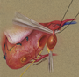 Small Parathyroidectomy Detail