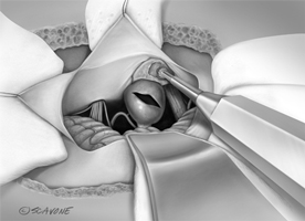 Acoustic Neuroma Surgery thumbnail