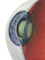 Cataract IOL Thumbnail