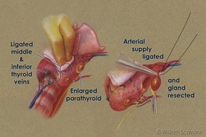 Parathyroidectomy thumbnail