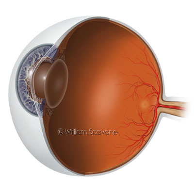 Globe of Eye Sectioned Through Optic Disc & Nerve